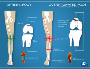 Knee Pain? Orthotics Can Help!