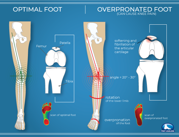 Pronation-vs-Optimal